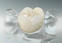 Fixed restorations - crowns and bridges | Hungarian Dental Care Netherlands Dentistry