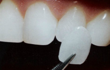 Fixed restorations - veneers | Hungarian Dental Care Netherlands Dentistry