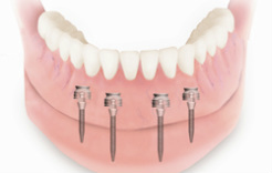 Removable prothetics - implant-supported dentures | Hungarian Dental Care Netherlands Dentistry