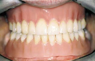 Removable restoration - detures | Hungarian Dental Care Netherlands Dentistry