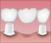 Fixed restorations - bridges | Hungarian Dental Care Netherlands Dentistry