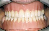 Removables - denture | Hungarian Dental Care Netherlands Dentistry