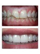Veneers | Hungarian Dental Care Netherlands Dentistry
