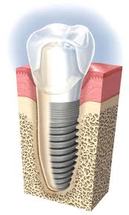 Dental implants | Hungarian Dental Care Netherlands Dentistry