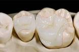 Fixed restorations - onlay | Hungarian Dental Care Netherlands Dentistry