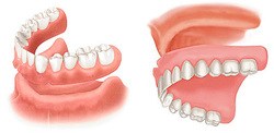 Removable prothetics - Full denture | Hungarian Dental Care Netherlands Dentistry