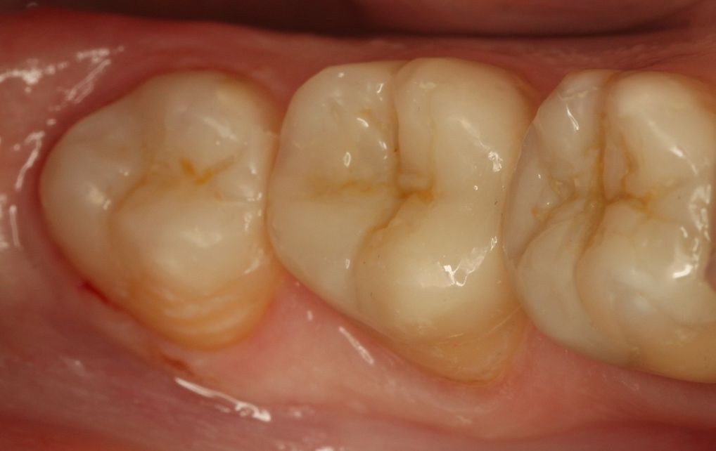 Fixed restorations - inlay, onlay | Hungarian Dental Care Netherlands Dentistry